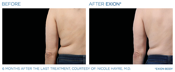 Fat Reduction case study 1