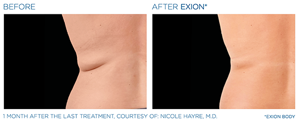 Fat Reduction case study 2
