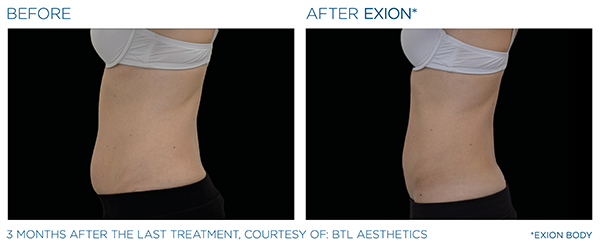 Fat Reduction case study 3