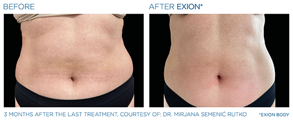 Skin Tightening case study 1