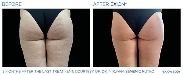 Skin Tightening case study 2