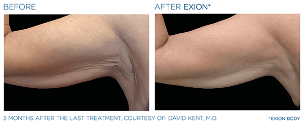 Skin Tightening case study 3