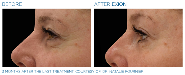 Before & After - Eyes 2