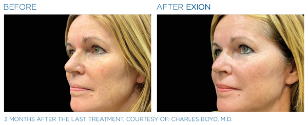 Before & After - Full Face 1