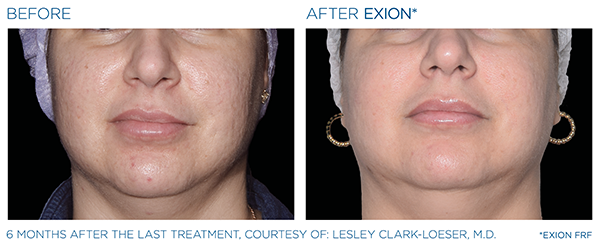 Acne Scars Case Study 1
