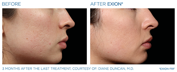 Acne Scars Case Study 2