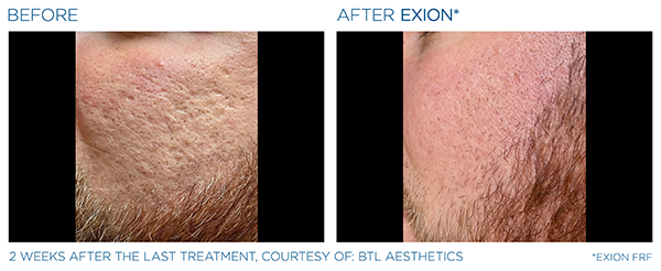 Acne Scars Case Study 3