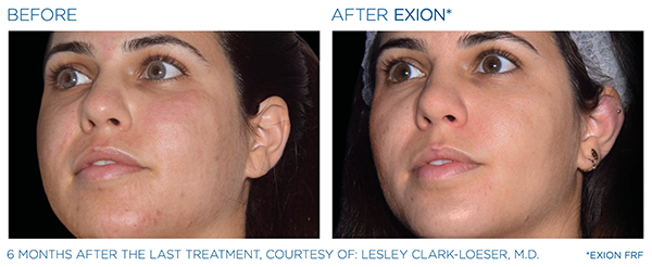 Acne Scars Case Study 4