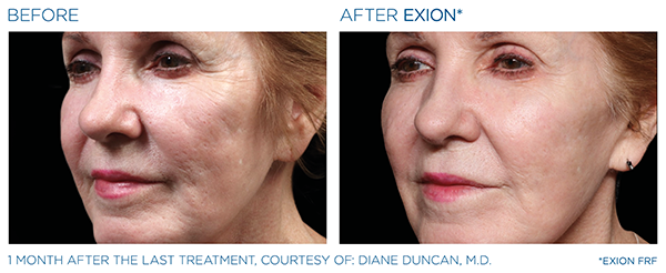 Wrinkle Reduction Case Study 1