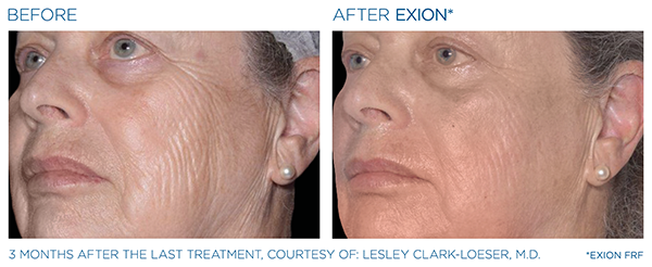 Wrinkle Reduction Case Study 2